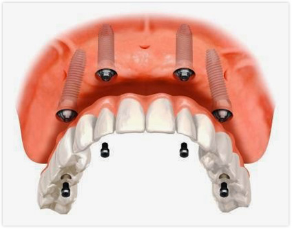 Dental-Implants-Aventura-FL