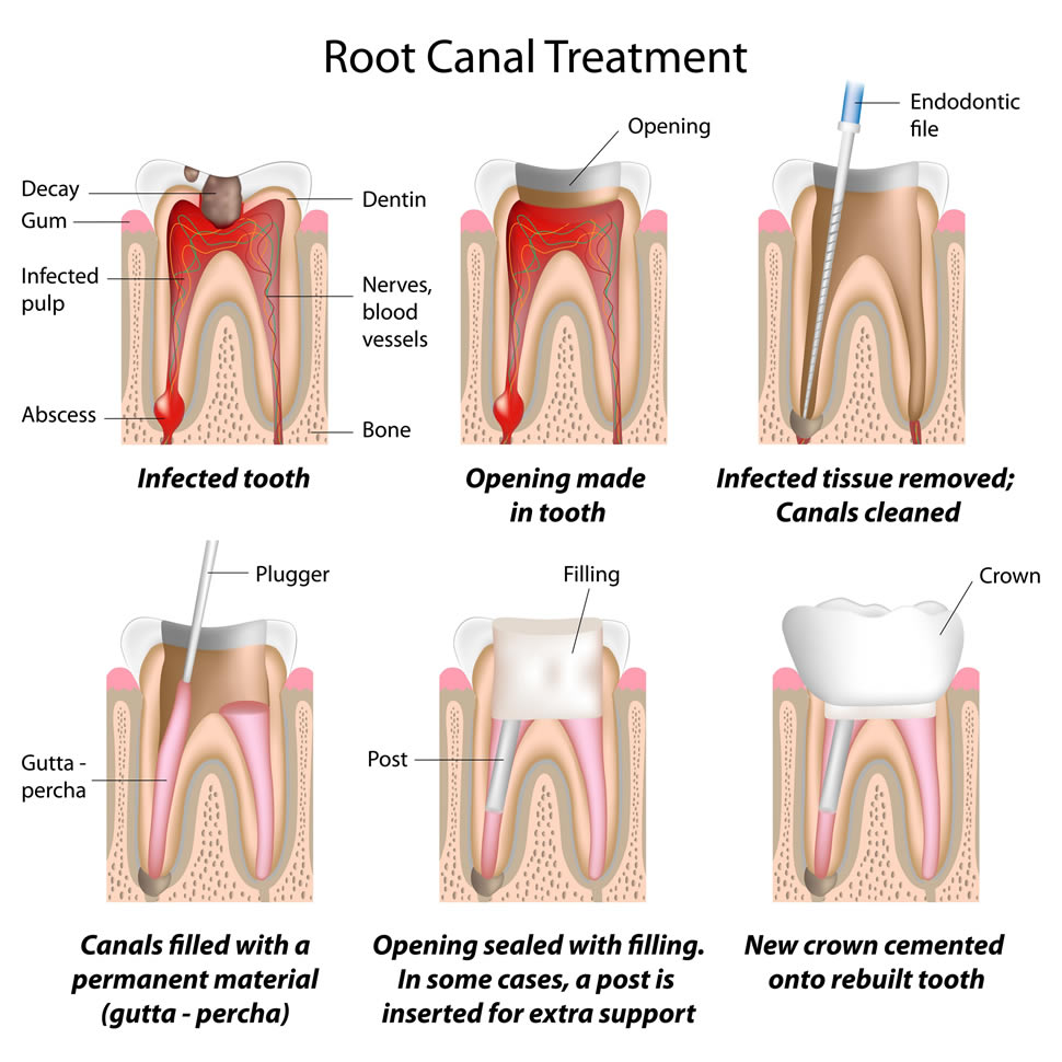 root-canal-1
