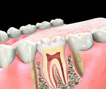 rootcanal3